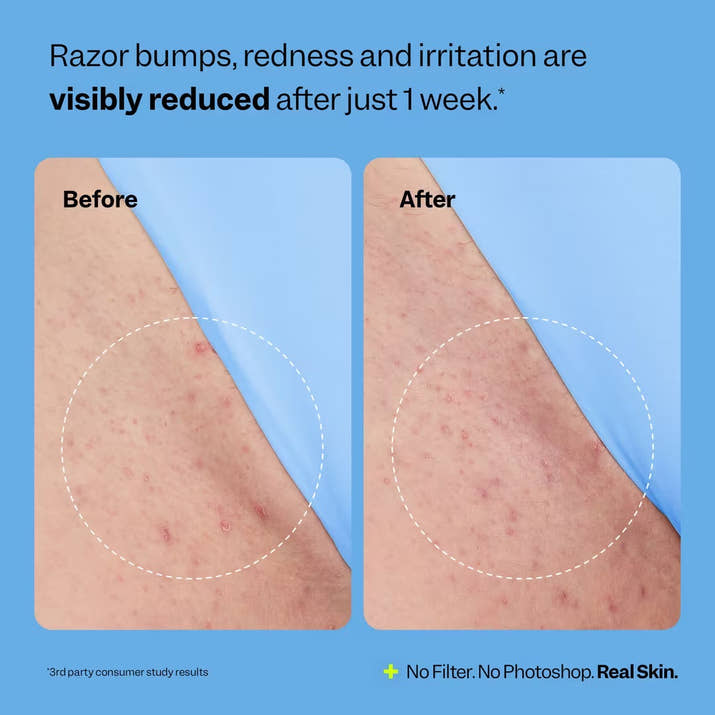 Silque™ Smoothing Solution Ingrown Hair Treatment